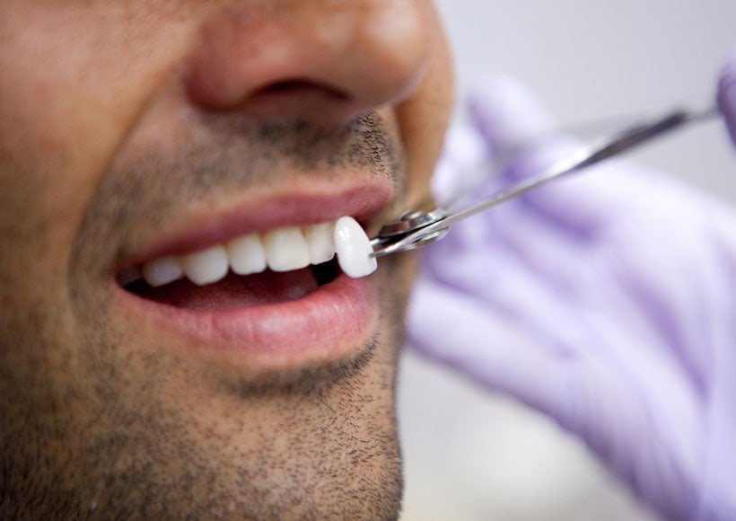 Close-up of a flawless white smile achieved with custom porcelain veneers